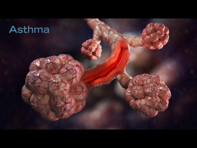 Asthma Causes & Treatment Video Animation