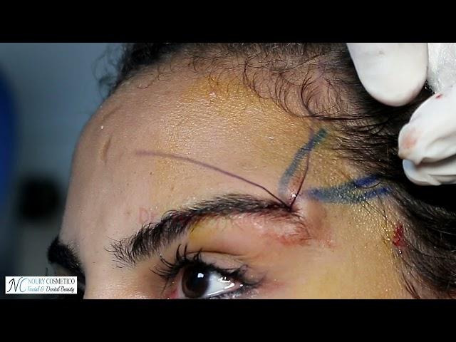 Cat eye ( eyebrow thread lift ) - Dr. Noury Adel