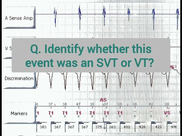 Device interrogation quiz ll VT or SVT?