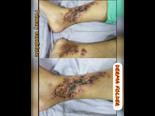 short case: livedoid vasculopathy