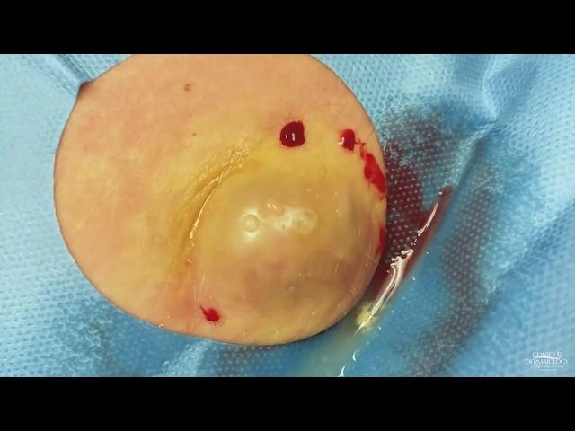 Cyst Squeezed to The Last Blob