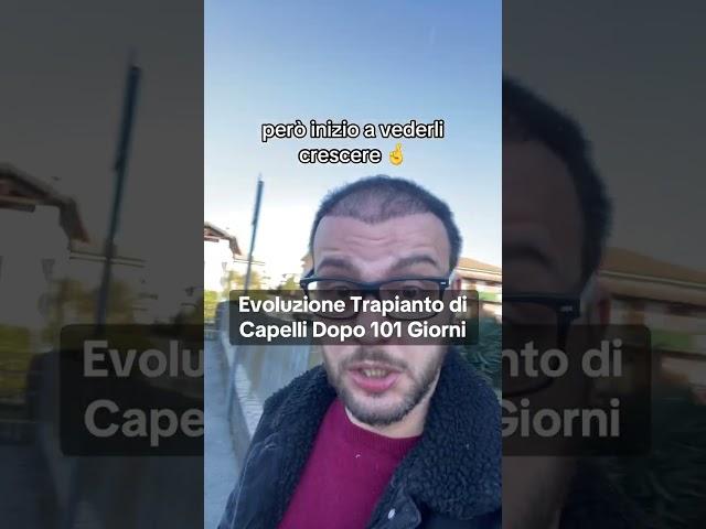 Evoluzione Trapianto di Capelli Dopo 101 Giorni ‍️‍️ #trapianto #trapiantocapelli