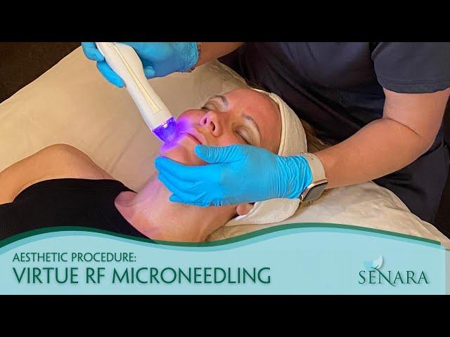 RF Microneedling Treatment Demo | Senara Health and Healing Center & Spa