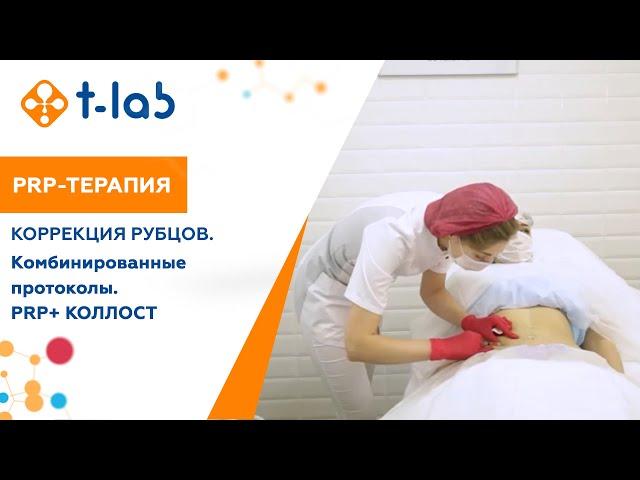 Коррекция рубцов. Комбинированные протоколы: PRP + КОЛЛОСТ.