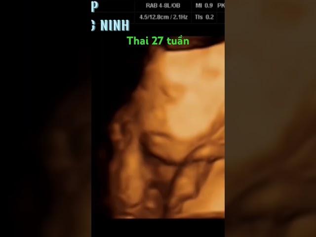 27 weeks pregnant on ultrasound/ Thai 27 tuần -Siêu âm Thảo Hiệp- Yên Phụ Yên Phong Bắc Ninh