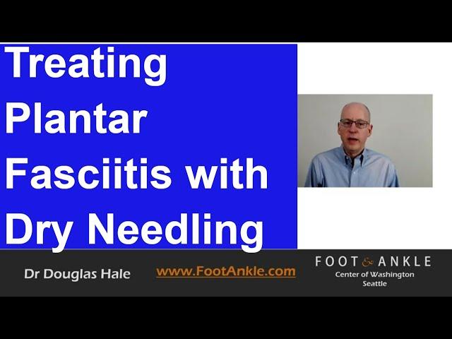 Dry Needling for Plantar Fasciitis | Seattle Podiatrist