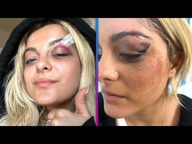 Bebe Rexha Fan Hit Singer With Phone, Thinking 'It Would Be Funny’