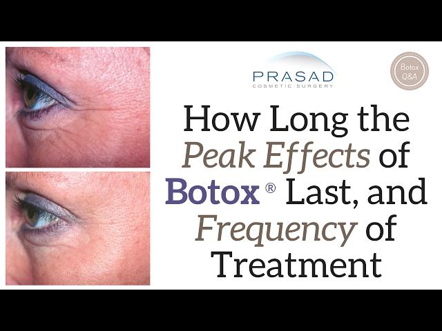 How Long Botox® can Last, and Why Lack of Movement Doesn't Make it Last Longer