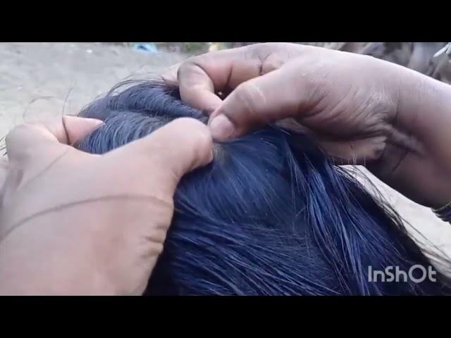 #oil hair#lice nit picking #by hands#most requested video #subsribe #pls