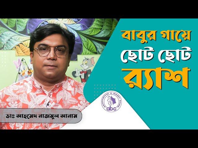 বাবুর গায়ে ছোট ছোট র‌্যাশ ||  ডাঃ আহমেদ নাজমুল আনাম || FCPS, MD- Assistant Professor, ICMH