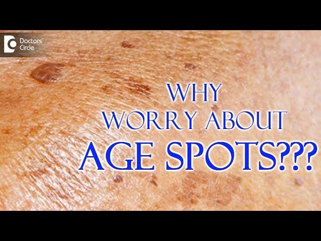 What are age spots? Can you get rid of age spots? - Dr. Nischal K