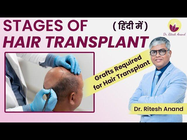 Best Stage To Get  Hair Transplantation Done | FUT vs FUE Techniques | Numbers of Grafts Required