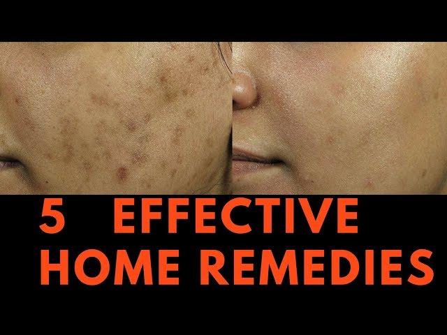 5 EFFECTIVE Home Remedies for Skin Pigmentation, Brown Spots and freckles