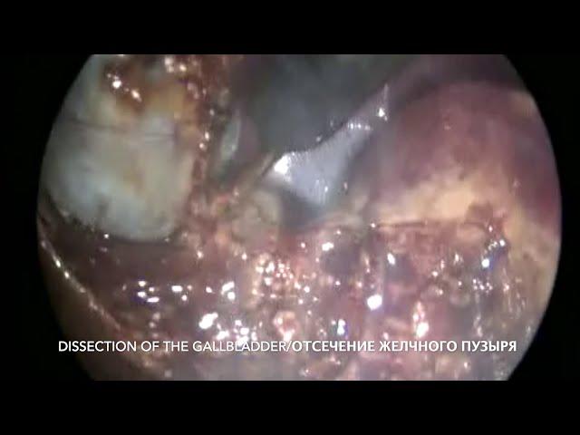 Lap Cholecystectomy, 10 yo, York/Лап. Холецистэктомия, Йорк, 10 лет