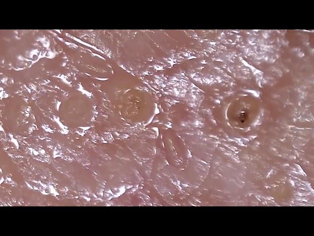 My Face Skin Demodex video