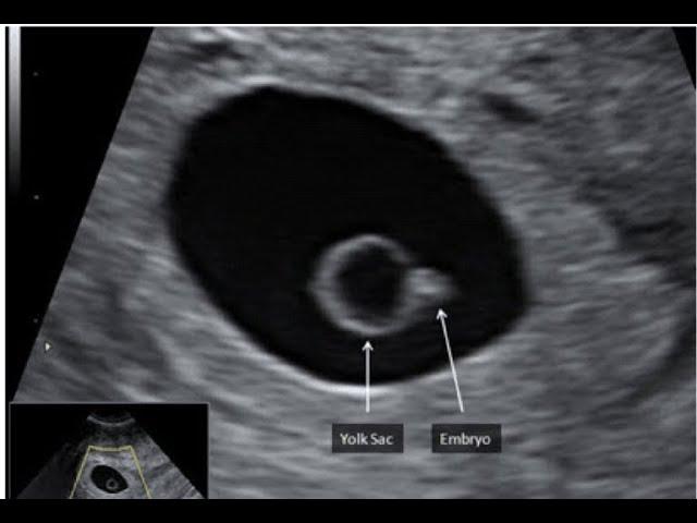 Ultrasound 6 Weeks Gestation |Early pregnancy scan |