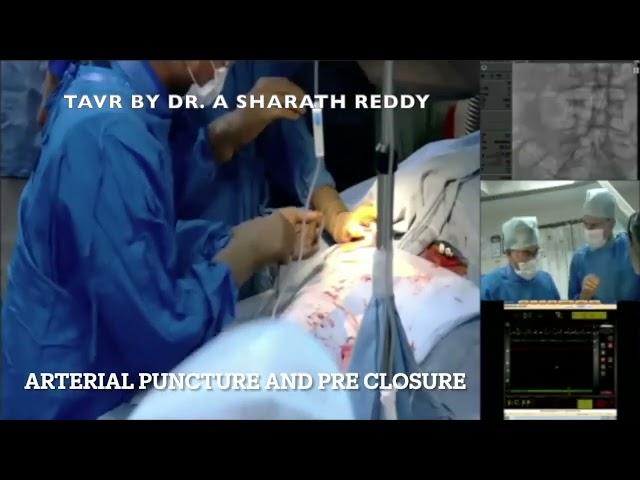 Live TAVR Procedure: Witness the Revolutionary Minimally Invasive Heart Surgery | Dr. Sharath Reddy