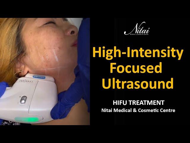 High-Intensity Focused Ultrasound - HIFU Treatment - Nitai Cosmetics Melbourne