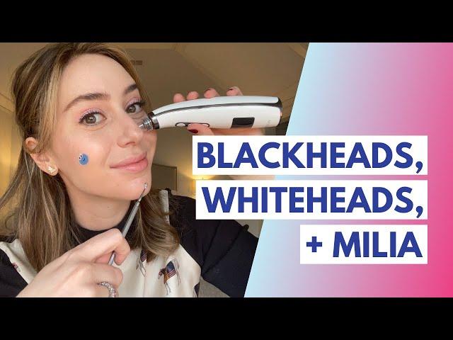 Blackheads vs. Whiteheads vs. Milia: What is the Difference + How to Treat! | Dr. Shereene Idriss