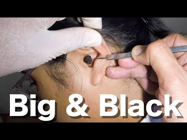 Big Black Earwax STUCK in Young Woman's Ear Removed