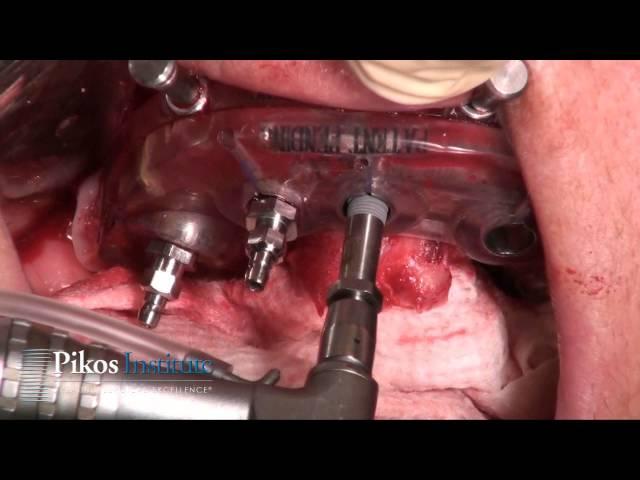 Surgery Video Full Arch Guided, All on 4, Same Day Teeth Implant Course