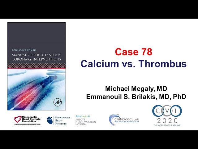 Case 78: PCI Manual - Calcium vs thrombus