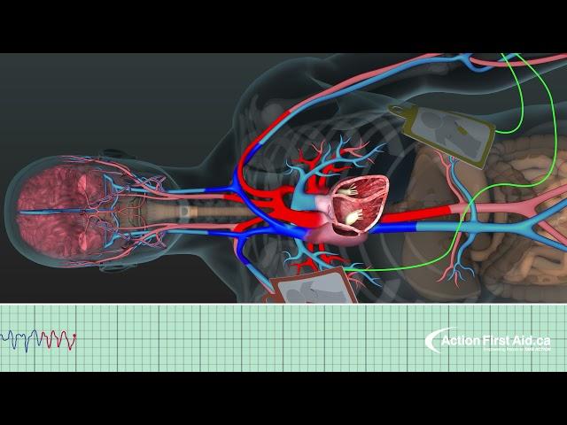 AED in Action | A 3D Look Inside the Body