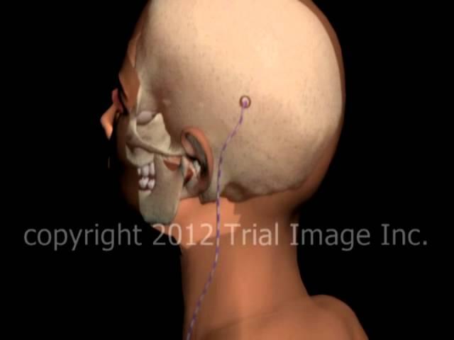 Hydrocephalus shunt video  by Dr. Cal Shipley, M.D.