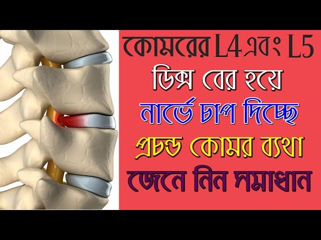 কোমরের এল ৪ , এল ৫ এ ব্যথা ! জেনে নিন সঠিক চিকিৎসা/ L4 L5 disc bulge treatment without surgery