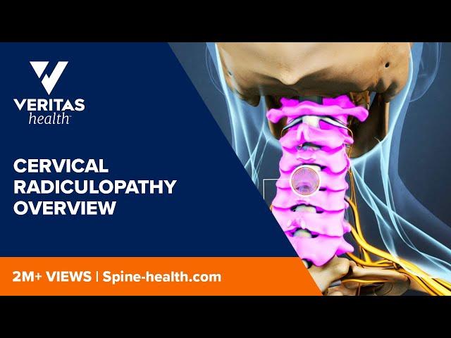 Cervical Radiculopathy Overview