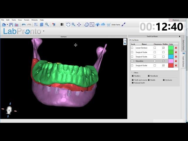 How 30 minutes could save you $3000 per arch on full arch implants