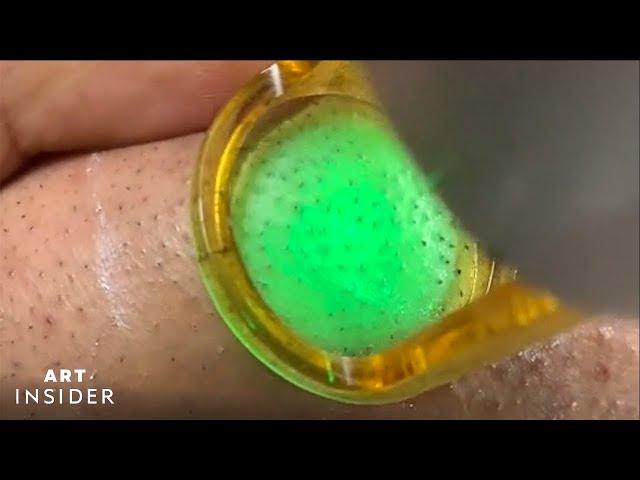 Laser Zaps Out Ingrown Hairs | Art Insider