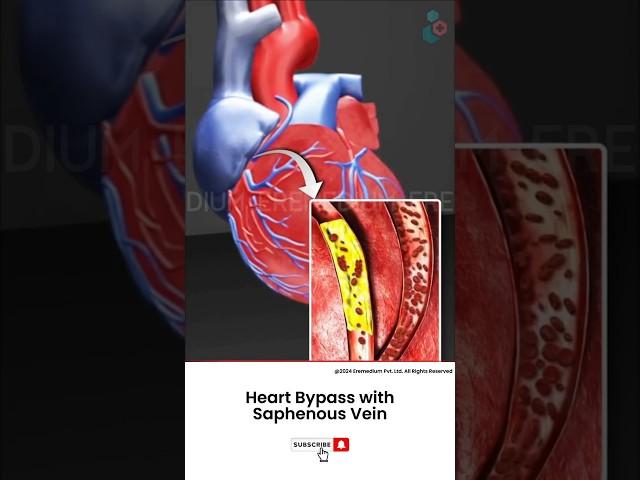 How Does Heart Bypass Surgery Work? ↪ 3D Medical Animation #Shorts #SaphenousVein