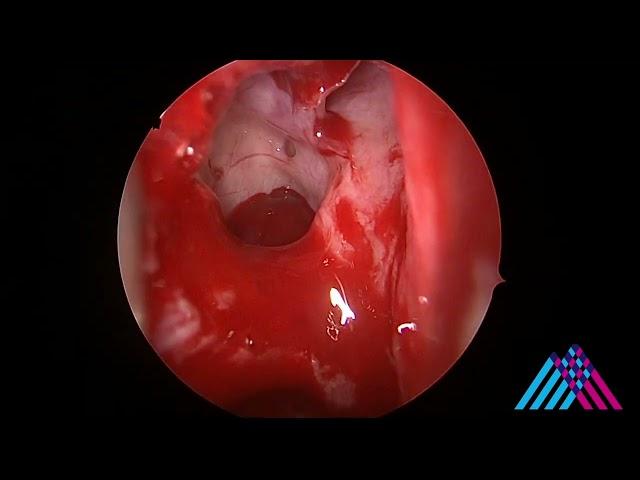 Functional Endoscopic Sinus Surgery (FESS) for sinusitis