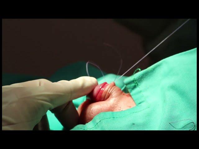 Circumcision For Neonates: 5 minutes, Bloodless with Thermocautery