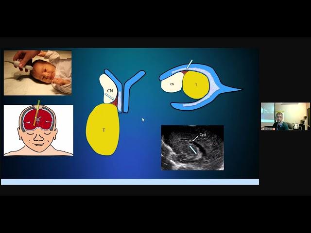 Pediatric Cranial Ultrasound - Dr. Ali Yikilmaz