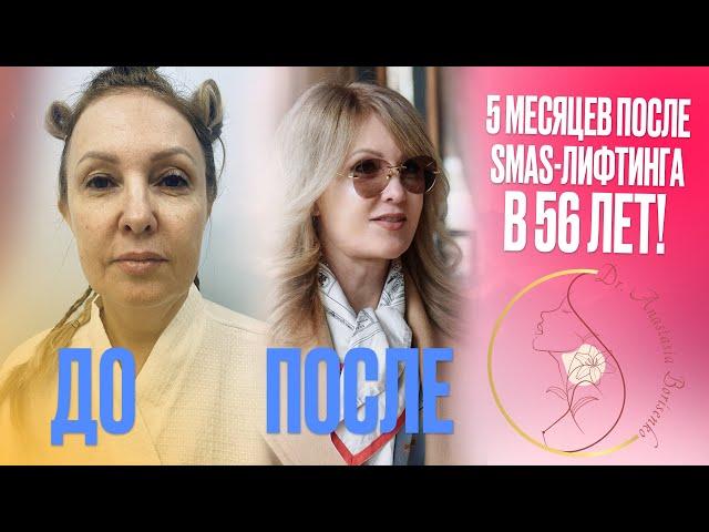 5 месяцев после SMAS-лифтинга в 56 лет!