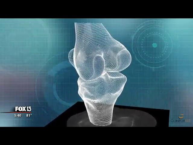 ConforMIS Knee Replacement Segment with Dr. Palumbo - Florida Orthopaedic Institute