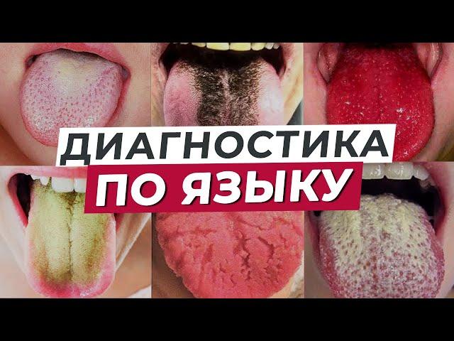 ЯЗЫК — зеркало организма! / Как определить состояние организма по языку?