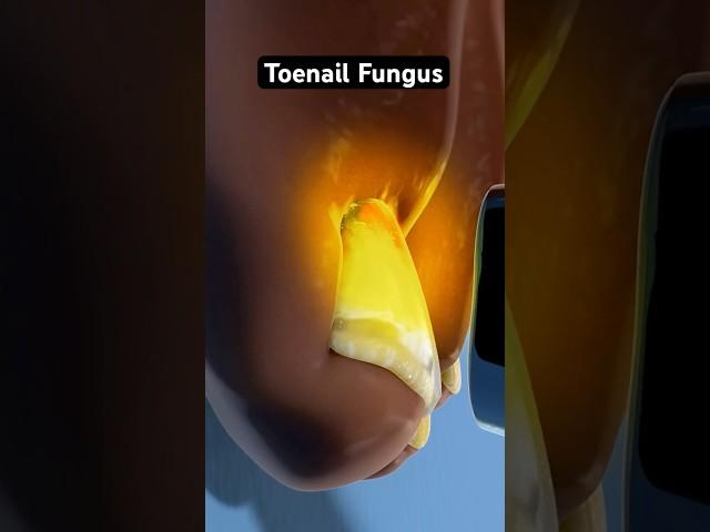 Eliminating persistent toenail fungus (3D Animation)