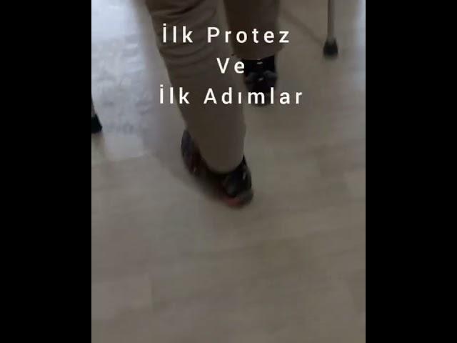 DİZALTI PROTEZ-BACAK PROTEZİ-VAKUMLU PROTEZ-PROTEZ BACAK-AKTİF VAKUM PROTEZ-SİLİKON PROTEZ