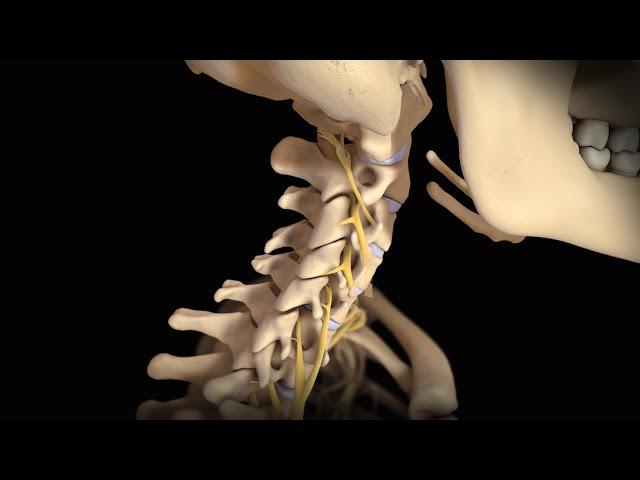 Neck Surgery | Cervical Disc Replacement | Nucleus Health