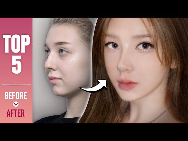 TOP5 Best Transformations at NANA l Plastic Surgery in Korea