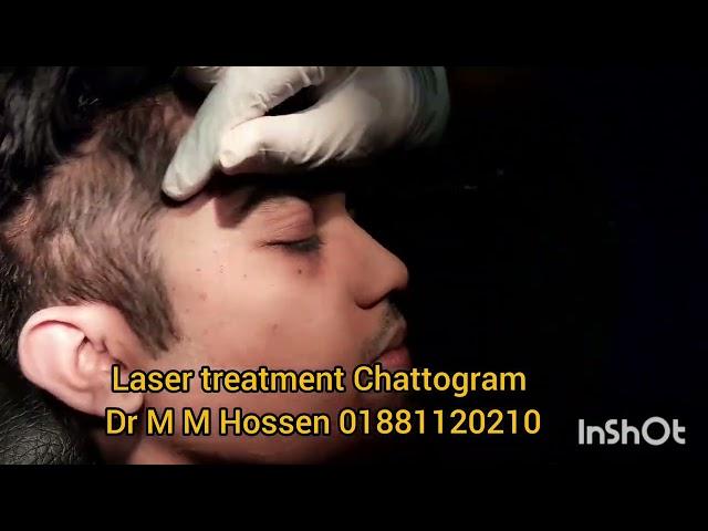 Syringoma laser treatment in Chittagong ছোট ছোট বিচি/ টিউমার এর লেজার চিকিৎসা চট্টগ্রামে ০১৮৮১১২০২১০