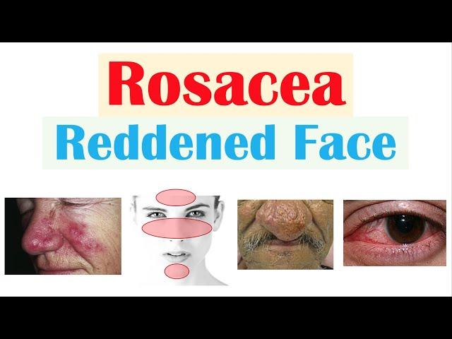 Rosacea (Red Lesions on Face) | Causes, Triggers, Types, Signs & Symptoms, Diagnosis, Treatment