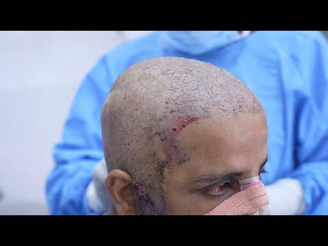 Step by Step FUE Hair Transplant Surgery in India | Richardson Face Hospital