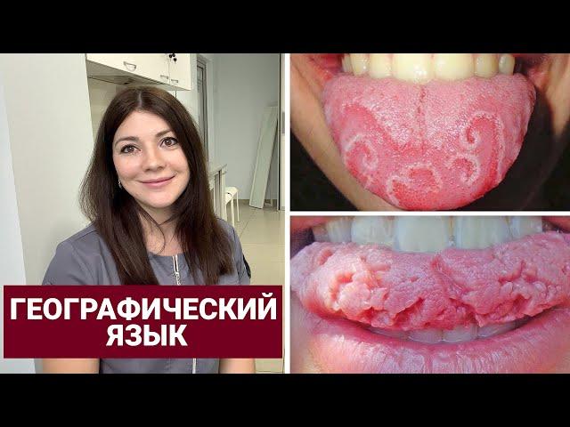 How to treat geographic tongue?