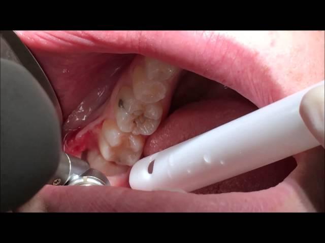 Surgical extraction of horizontally impacted 38. Wisdom tooth extraction Ipswich