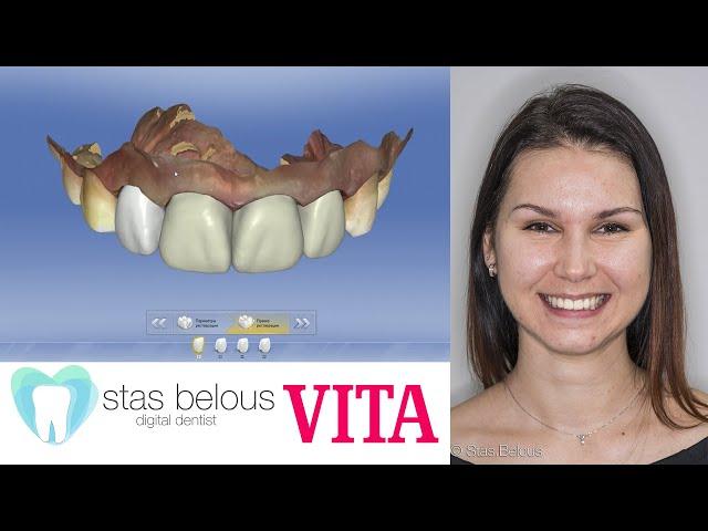 Vita Cad Temp cerec omnicam Stas Belous temporary crowns #Suprinity or Emax veneers #vitazahnfabrik