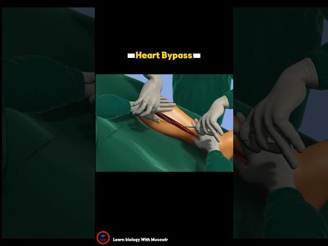 Heart Bypass Surgery Procedure - 3D video _ #cardiology #short